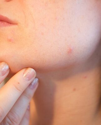 Jak samemu usunąć zaskórniki?